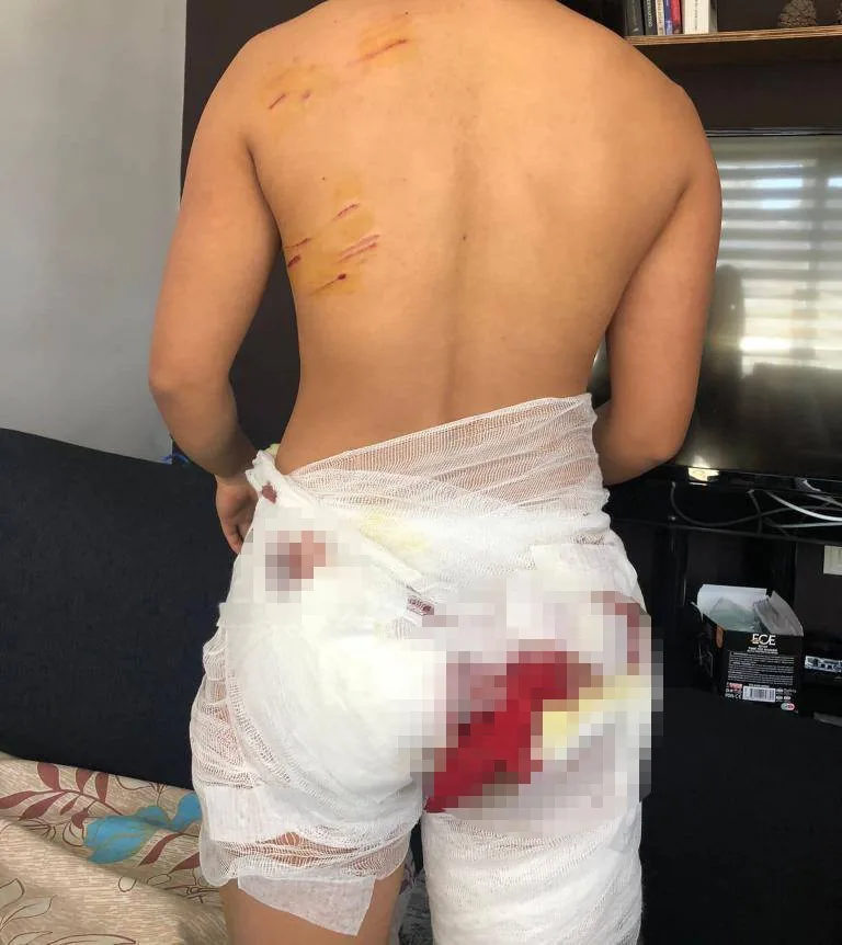 Antalya’da sokak köpeklerinin saldırısına uğrayan Endonezyalı kadın ağır yaralandı